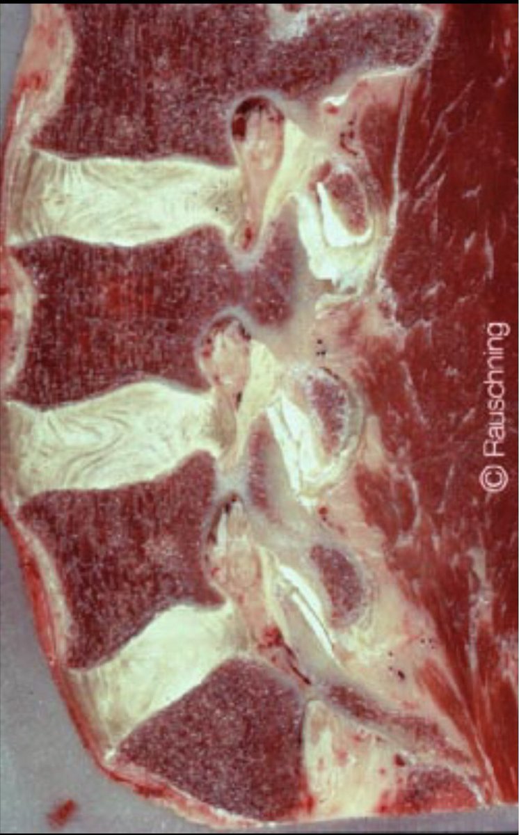 Retlouping's tweet image. The difference in Cervical and Lumbar foramen and nerve root positions. 

Note cervical roots sit in the superior notch (inferior foramen) , whilst lumbar sit int he inferior notch (superior foramen)