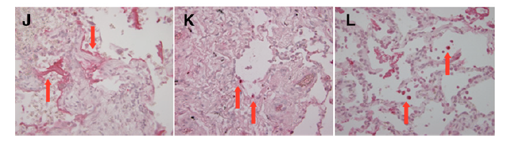 KaminskiMed's tweet photo. @leticiakawano @virenkaul @aasimhasany @KerriBerriKerri @AneesaDas @subanichandra @GallodeMoraesMD @gretchemaben @accpchest I'm not aware of studies comparing tissue histology in early vs late #AEIPF. In our molecular profiling study (old, but still the ONLY one methinks) we saw cell death and DAD, but no evidence for the type of inflammation one would treat with steroids https://t.co/f0BSe8Pclf https://t.co/v9vX1rEJhf