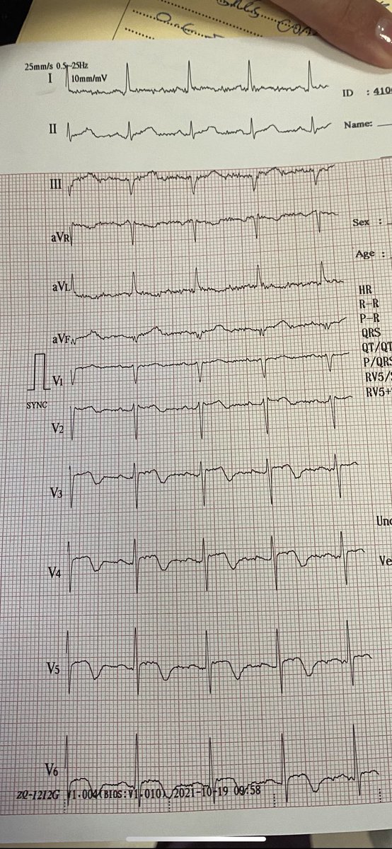 80 years old female with syncopal attack. 
VT with high troponin. Thoughts on ECG? 
#cardiotwitter #PEEPS #FOAMed #MedEd #ECG #ECGchallenge