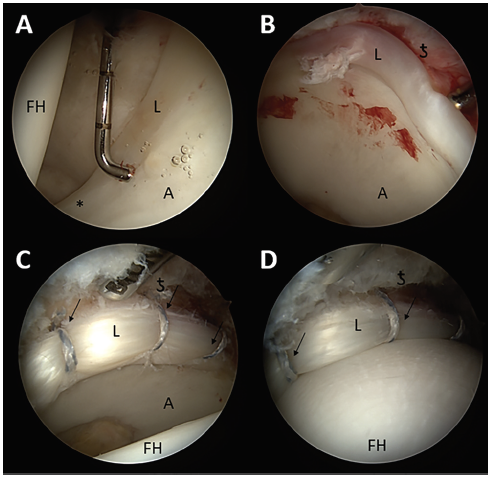 MaldonadoMD_'s tweet photo. Based on the findings of our new study, #labralrepair remains the gold standard treatment for viable
labrum for patients>40-y, while #labralreconstruction is
a useful alternative for irreparable #labraltears
#FAI #Hiparthroscopy
https://t.co/LSjaaHw6mr https://t.co/tO7D2riKJg