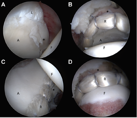 MaldonadoMD_'s tweet photo. Based on the findings of our new study, #labralrepair remains the gold standard treatment for viable
labrum for patients>40-y, while #labralreconstruction is
a useful alternative for irreparable #labraltears
#FAI #Hiparthroscopy
https://t.co/LSjaaHw6mr https://t.co/tO7D2riKJg