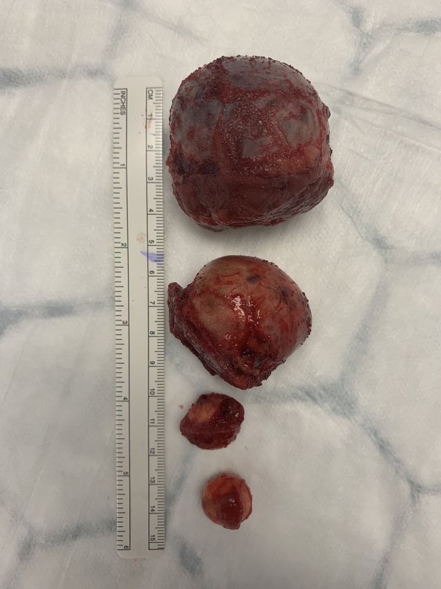 MHussainUrol's tweet image. @FrimleyHealth investing in its surgical future with the latest @IntuitiveSurg Da Vinci Xi dual console robot 🎉 Put it through its paces for its first use with a quadruple retro partial nephrectomy 🦾 #innovation #robotics @NeilDardisFHFT @tblho @FrimleyRCC @FrimleyUrology