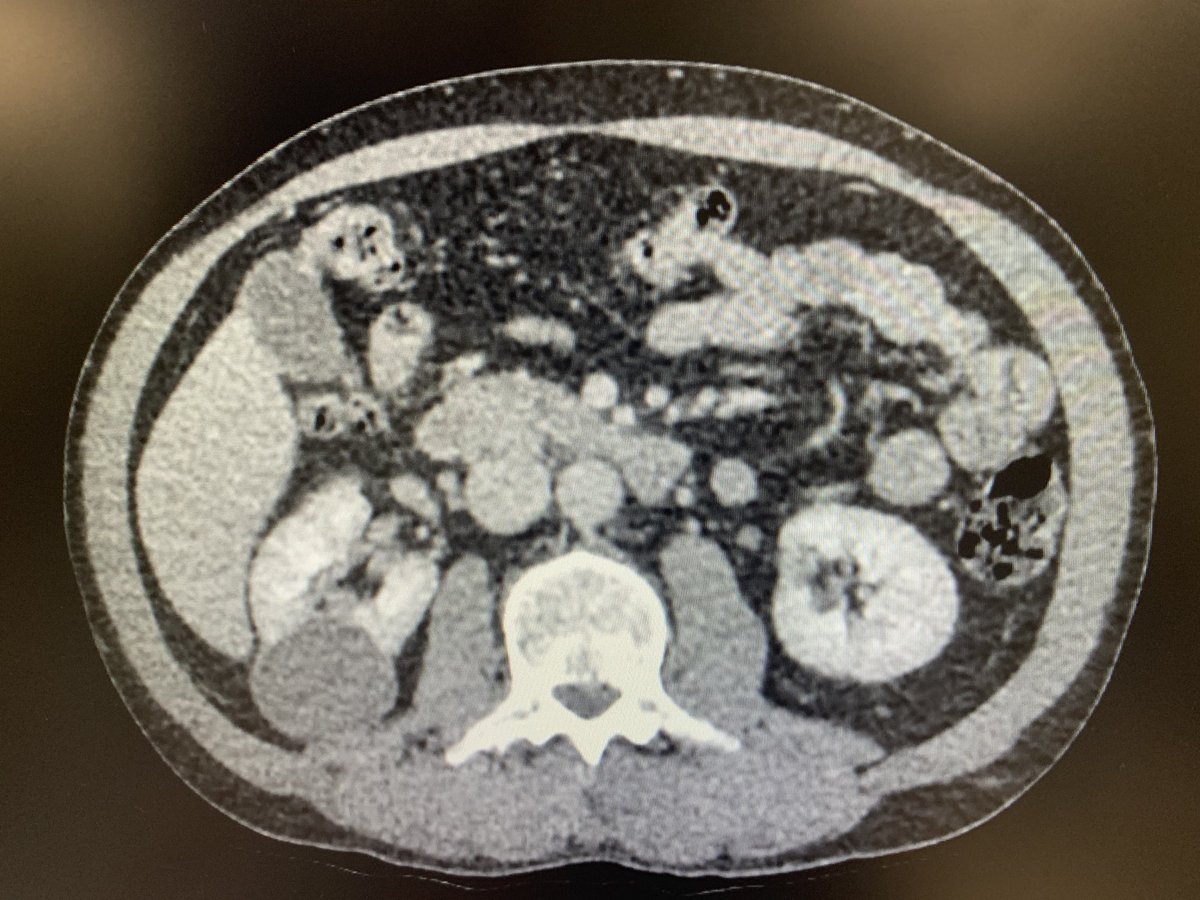 MHussainUrol's tweet image. @FrimleyHealth investing in its surgical future with the latest @IntuitiveSurg Da Vinci Xi dual console robot 🎉 Put it through its paces for its first use with a quadruple retro partial nephrectomy 🦾 #innovation #robotics @NeilDardisFHFT @tblho @FrimleyRCC @FrimleyUrology