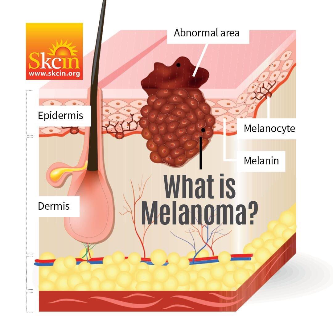 SkcinCharity's tweet photo. Melanoma begins in melanocytes – the cells that produce the pigment melanin that colours the skin, hair &amp; eyes. Melanocytes also form moles, where melanoma often, but not always develops.These cancerous growths develop when unrepaired DNA damage to skin cells trigger mutations… https://t.co/9wNtGKq4Gt