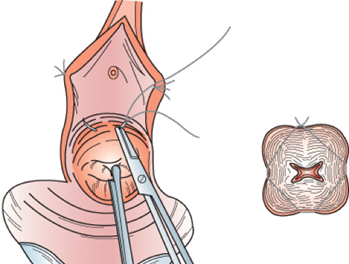 Emergency cervical #cerclage in #twin pregnancies with 0-mm cervical length or prolapsed membranes is as successful as in singleton pregnancies.
#openaccess @MrLawrenceImpey
doi.org/10.1111/aogs.1…