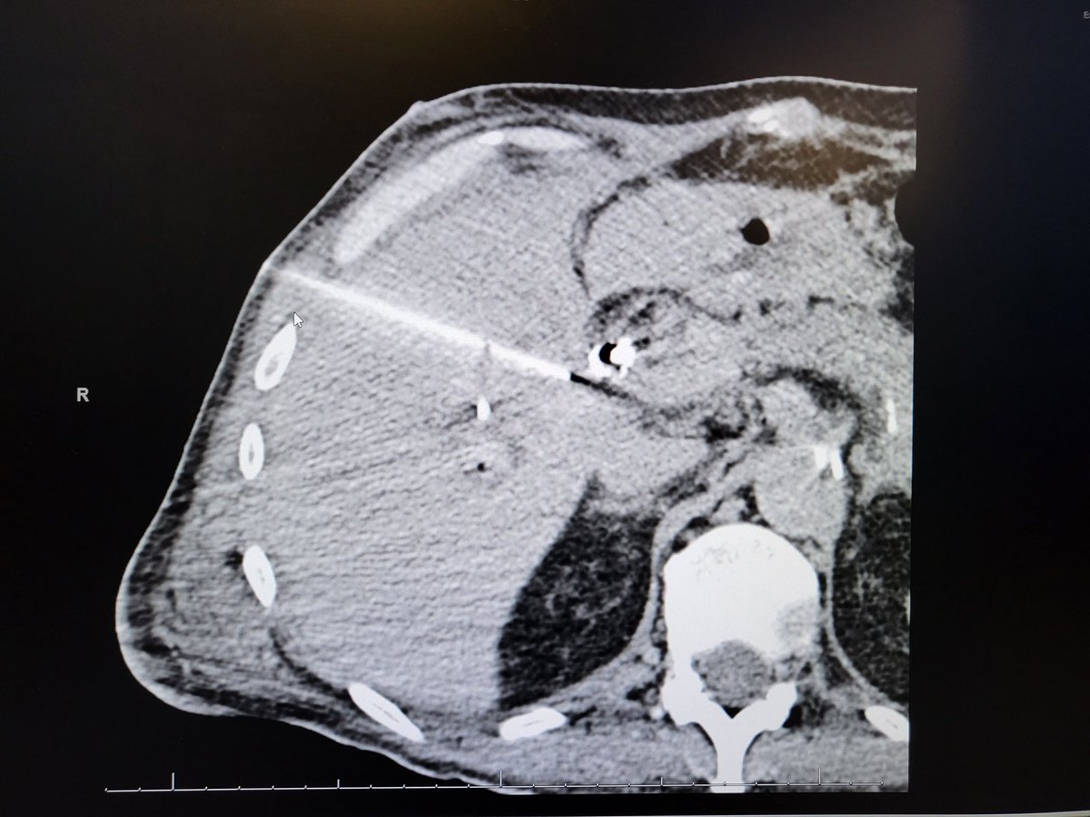 theblanketdog's tweet photo. Direct stick and glued after CTA with catheter in the celiac. H/H stabilized. Discharged home few days later. @TheRealDoctorOs
@CarlosGuevaraIR
@ZHaskal @AndrewNiekampMD @billmajdalany @DPryluck https://t.co/3NzVNp2ATY