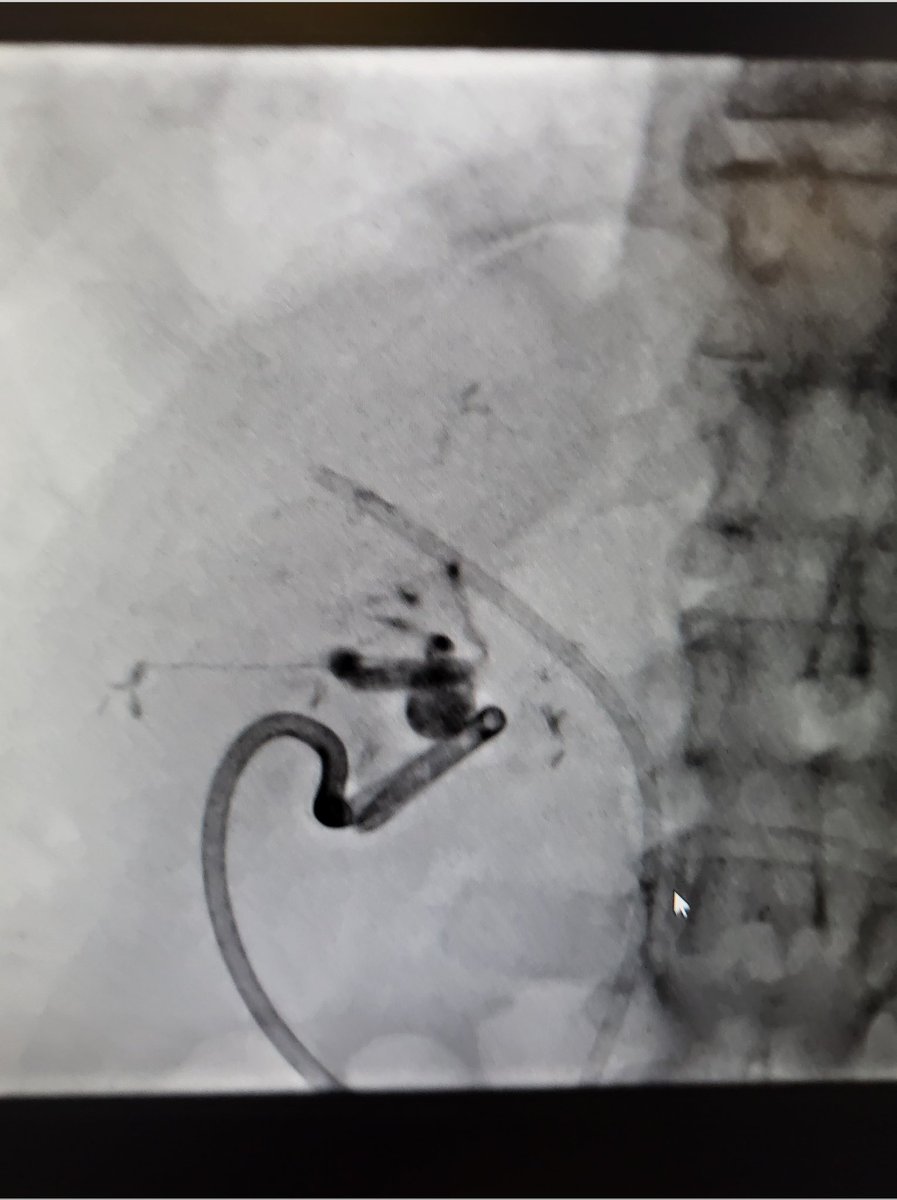 Blanket Dog (@theblanketdog) on Twitter photo Direct stick and glued after CTA with catheter in the celiac. H/H stabilized. Discharged home few days later. <a href="/TheRealDoctorOs/">Osman Ahmed</a>
<a href="/CarlosGuevaraIR/">Carlos Guevara MD, FSIR</a>
<a href="/ZHaskal/">Ziv J Haskal MD</a> <a href="/AndrewNiekampMD/">Andrew Niekamp</a> @billmajdalany <a href="/DPryluck/">David Pryluck MD MBA</a> Direct stick and glued after CTA with catheter in the celiac. H/H stabilized. Discharged home few days later. <a href="/TheRealDoctorOs/">Osman Ahmed</a>
<a href="/CarlosGuevaraIR/">Carlos Guevara MD, FSIR</a>
<a href="/ZHaskal/">Ziv J Haskal MD</a> <a href="/AndrewNiekampMD/">Andrew Niekamp</a> @billmajdalany <a href="/DPryluck/">David Pryluck MD MBA</a>