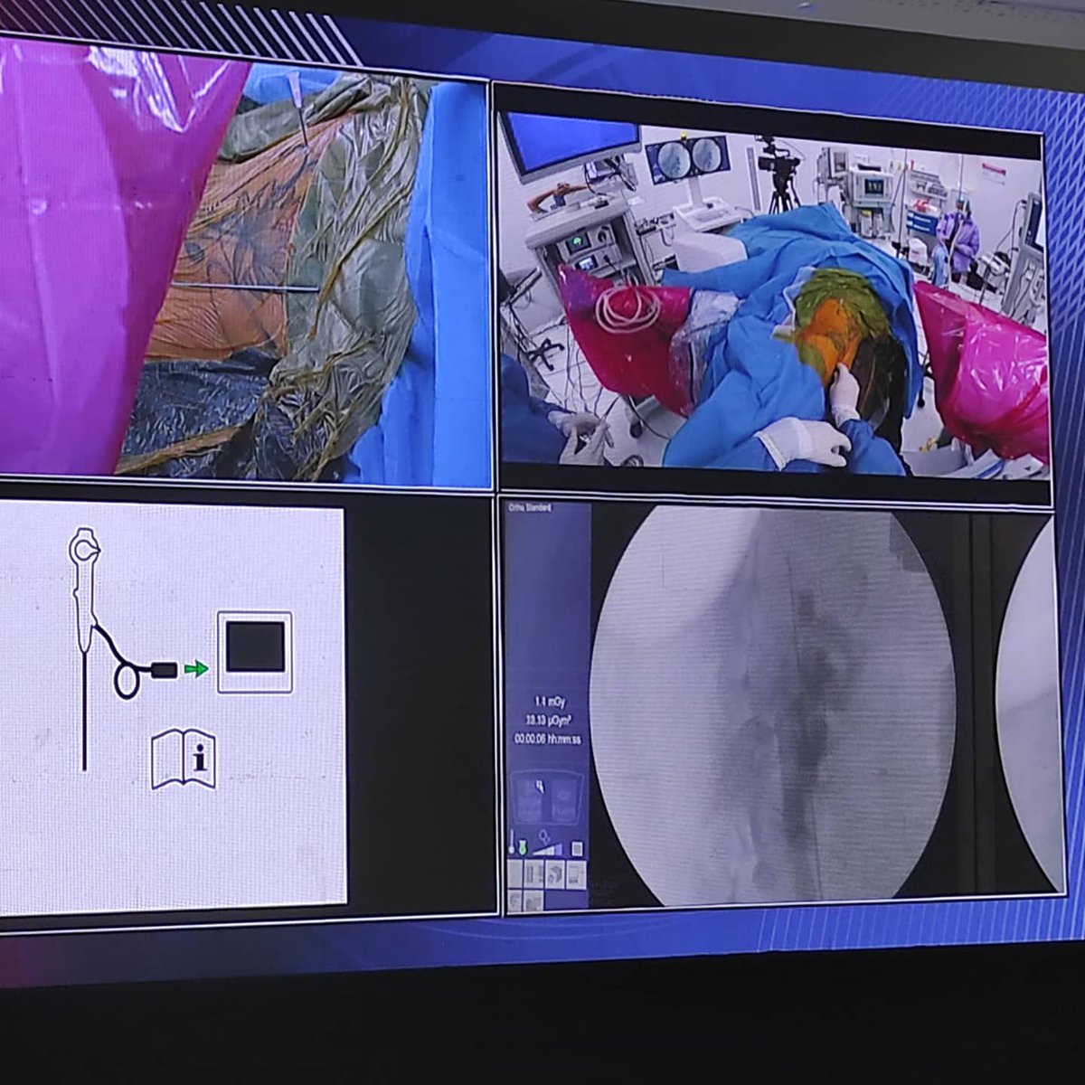 OSNOR's tweet photo. Excelente actividad académica acerca de Nefrolitotomia percutánea y Ureteroscopia flexible, realizada en Quito gracias a la invitación de Ecuasurgical. Contamos Con la presencia del Profesor: Braulio Manzo, quien nos visitó desde México mostrándonos una técnica eficaz y simple. https://t.co/3AWx3VhdzC