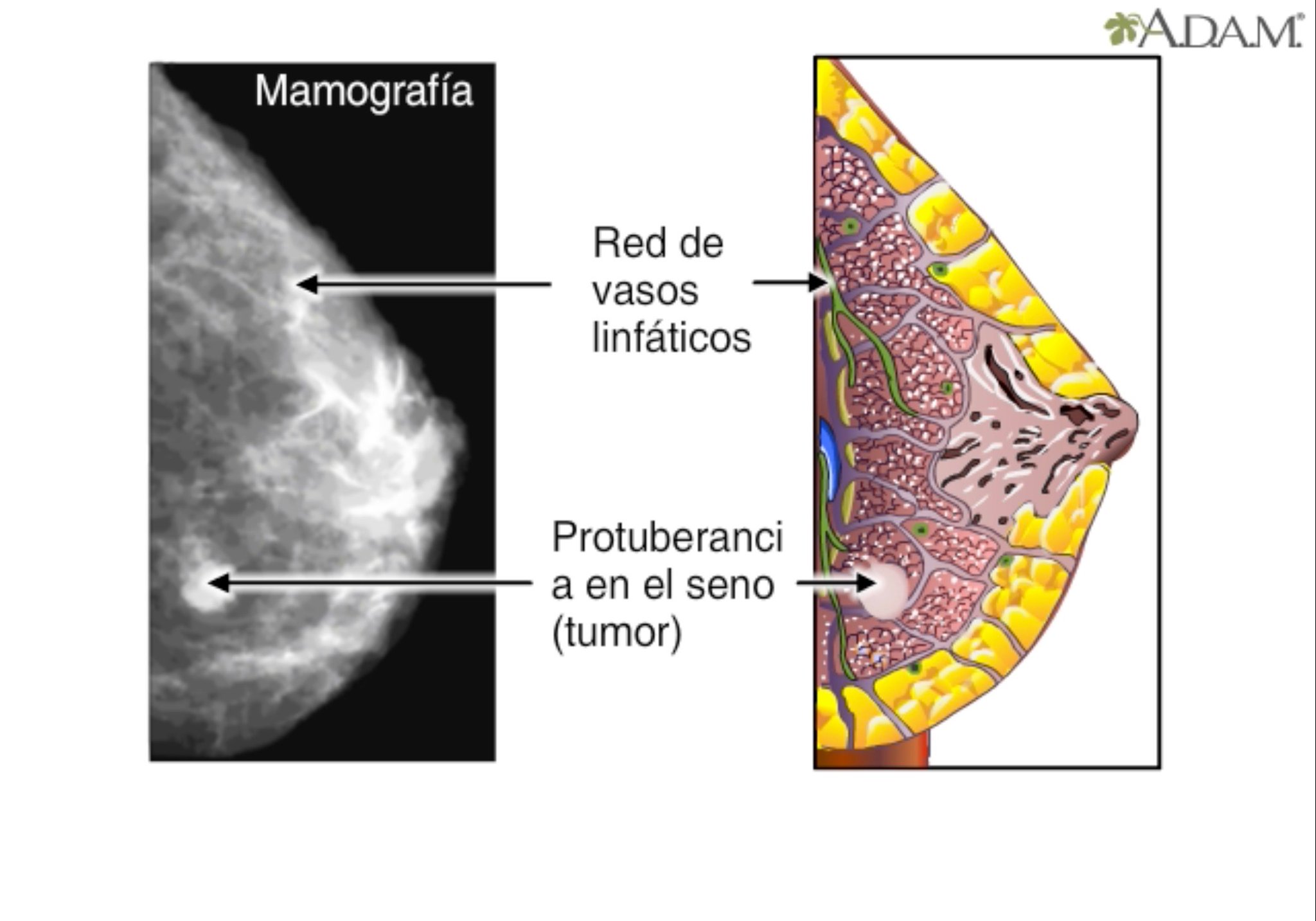 que es papilomatosis en seno