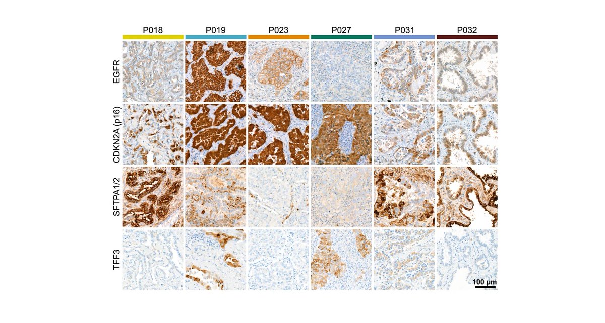 ExtracellMatrix's tweet photo. To identify clinically relevant #microenvironmental and cancer features, scientists from @HumboldtUni and @DKTK_ applied single-cell RNA sequencing to ten human lung adenocarcinomas and ten normal control tissues.

Read their findings: ⬇️ https://t.co/fZzzLUGahw https://t.co/l6ercjViH1