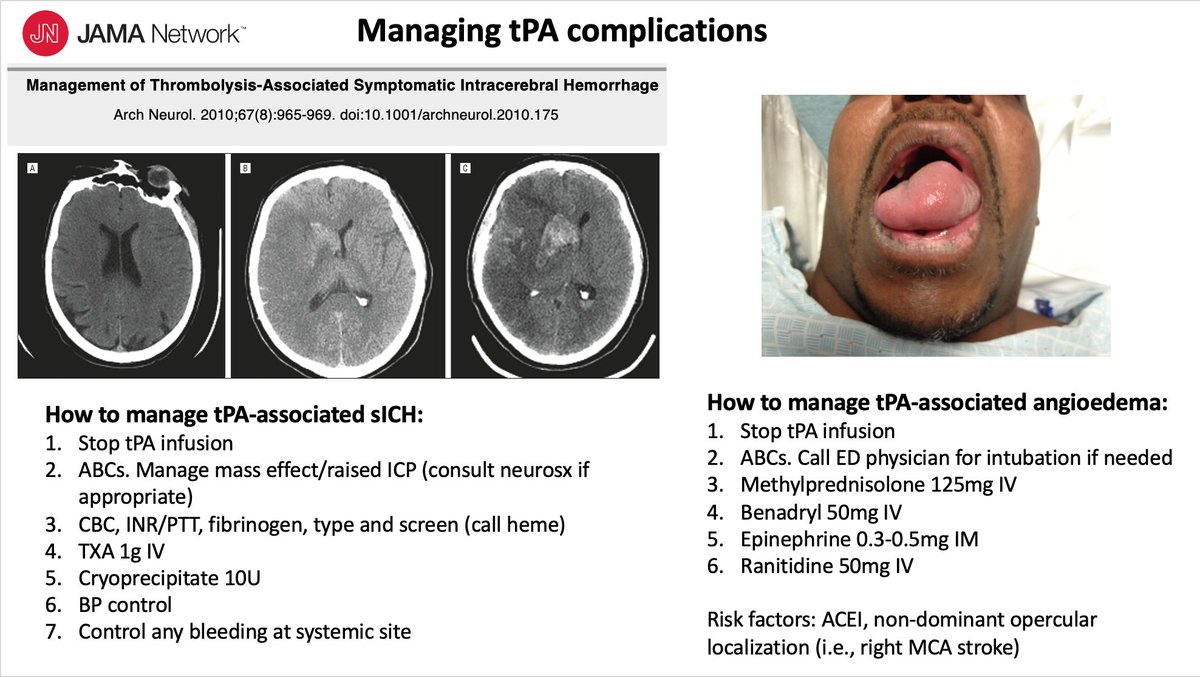 MicieliA_MD's tweet photo. Good to know what to do, if you ever run into this situation (as it is often not taught enough in residency)

Regional variation in protocols.

#neurotwitter #stroke #MedEd https://t.co/PbyclFKcHl