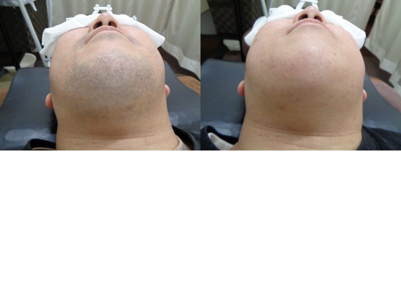 千葉ヒゲ脱毛 男性脱毛専門店ｌｕｘｙ Mensluxy Twitter