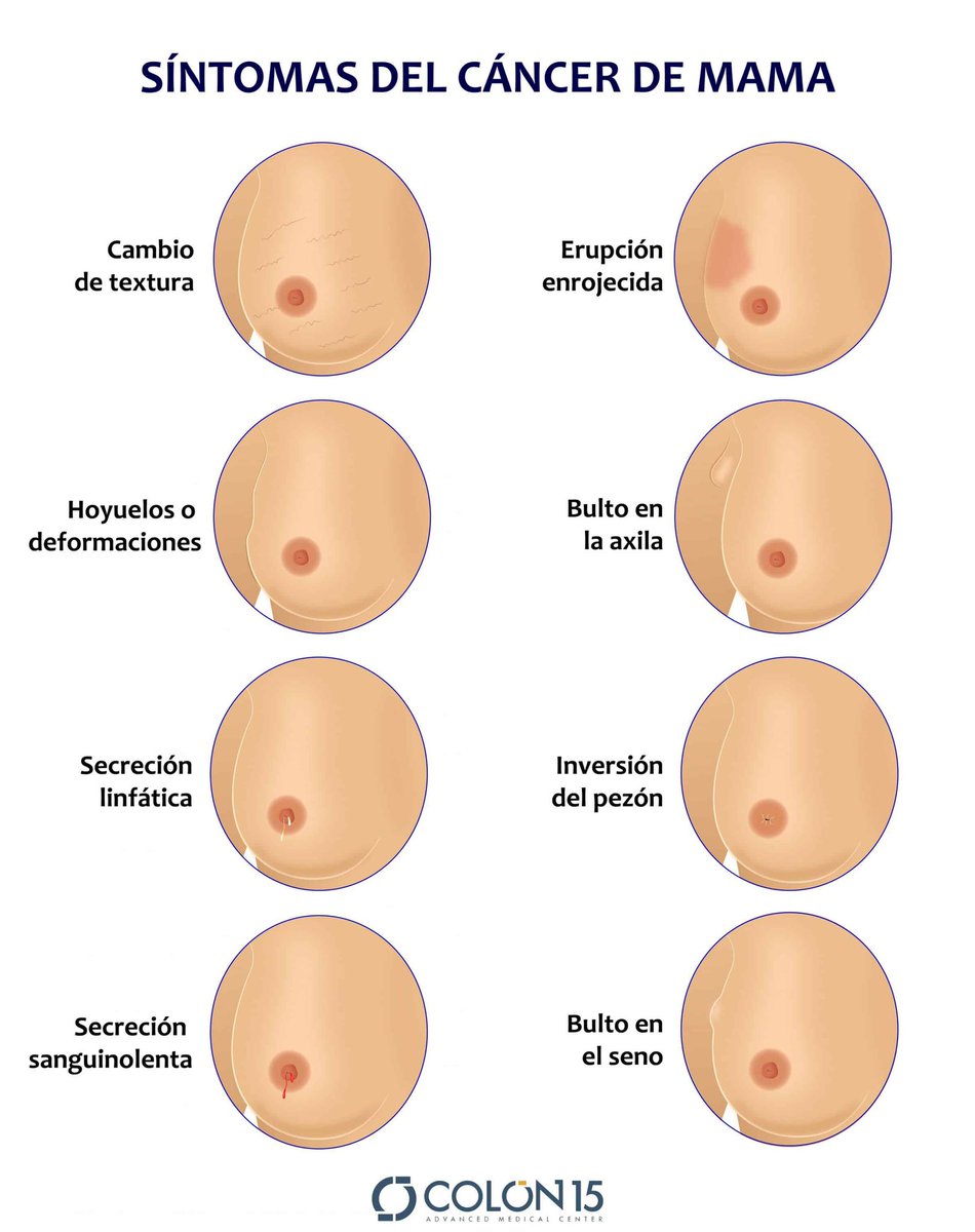 xiscons's tweet photo. ➡️ El 30% dels càncers en dones s'originen a la mama
➡️ 1 de cada 8 dones el patirà al llarg de la seva vida
➡️ L'edat de risc comença als 35
➡️ La detecció temprana suposa més d'un 90% de supervivència
#Tocat #DiaMundialdelCancerdeMama https://t.co/wsm2nk81Fh