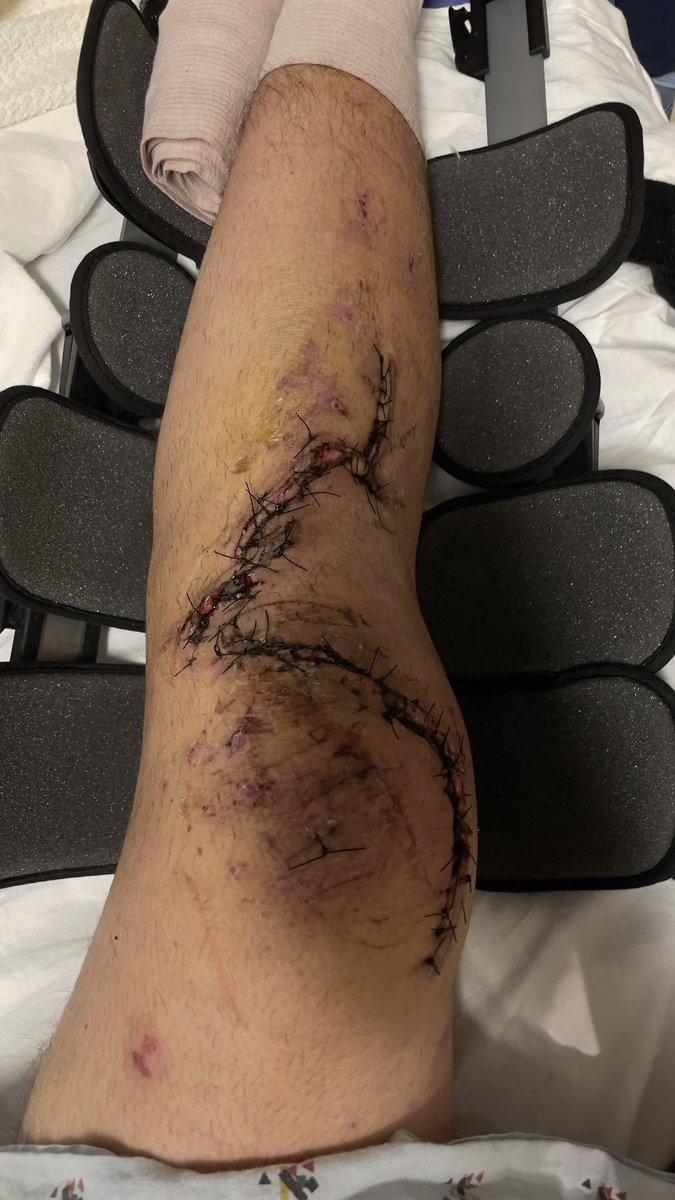 isaukers's tweet photo. @Justincraiger yes call me or text 801–949-7246 i’m crippled btw but somehow my jaw/face and right arm/hand were unharmed so i can visit and hop from place to place 🤘 https://t.co/DLID3SxJ4B