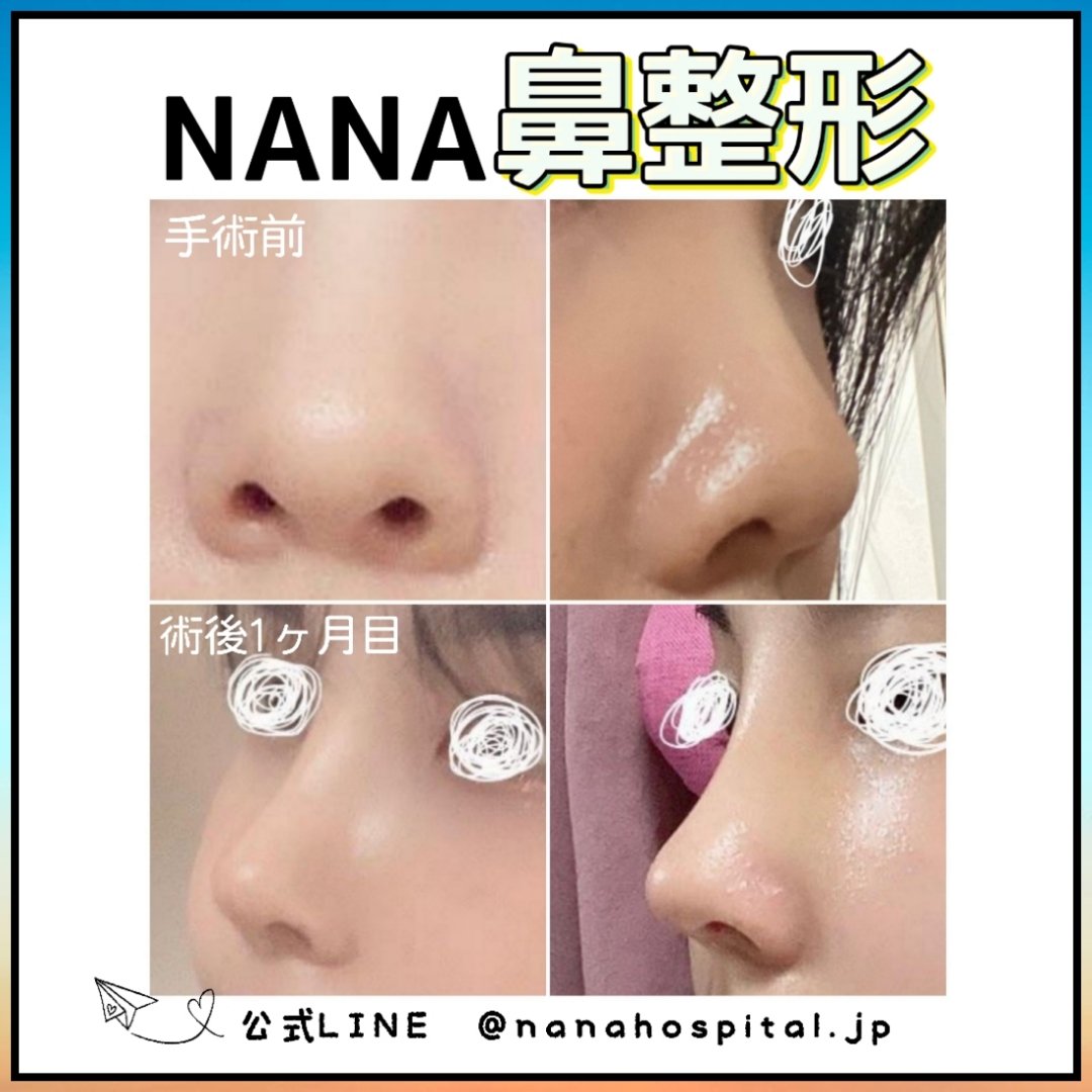韓国nana美容外科 韓国整形 Nana美容外科 低い鼻先と存在感のある 大きい鼻が悩み なら Nana鼻整形と骨幅寄せ 鷲鼻矯正で スリムで高い綺麗な鼻ライン完成 詳しくはお問い合わせ下さい 公式line T Co Uktu5b4nbb 韓国情報 韓国nana美容外科 韓国整形 Nana美容外科 低い鼻先と存在感のある 大きい鼻が悩み なら Nana鼻整形と骨幅寄せ 鷲鼻矯正で スリムで高い綺麗な鼻ライン完成 詳しくはお問い合わせ下さい 公式line T Co Uktu5b4nbb 韓国情報
