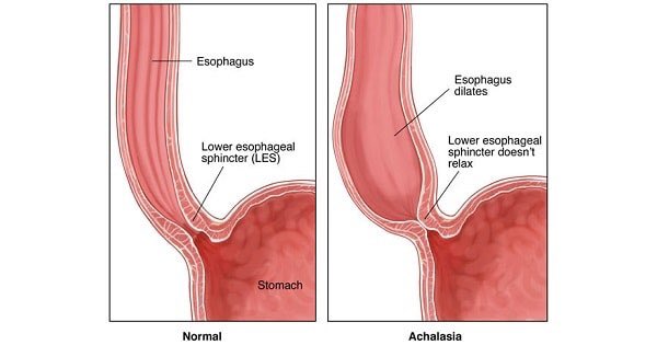 TomekaNapper's tweet photo. I'm still raising #Achalasia awareness.
#HelpTomekaEatAgain https://t.co/fbM3Ffpmk0