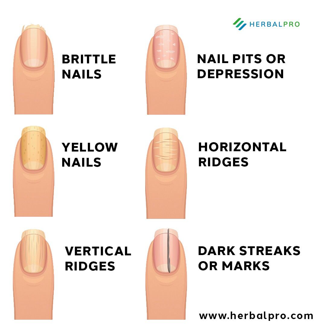Top 156+ white nail syndrome causes