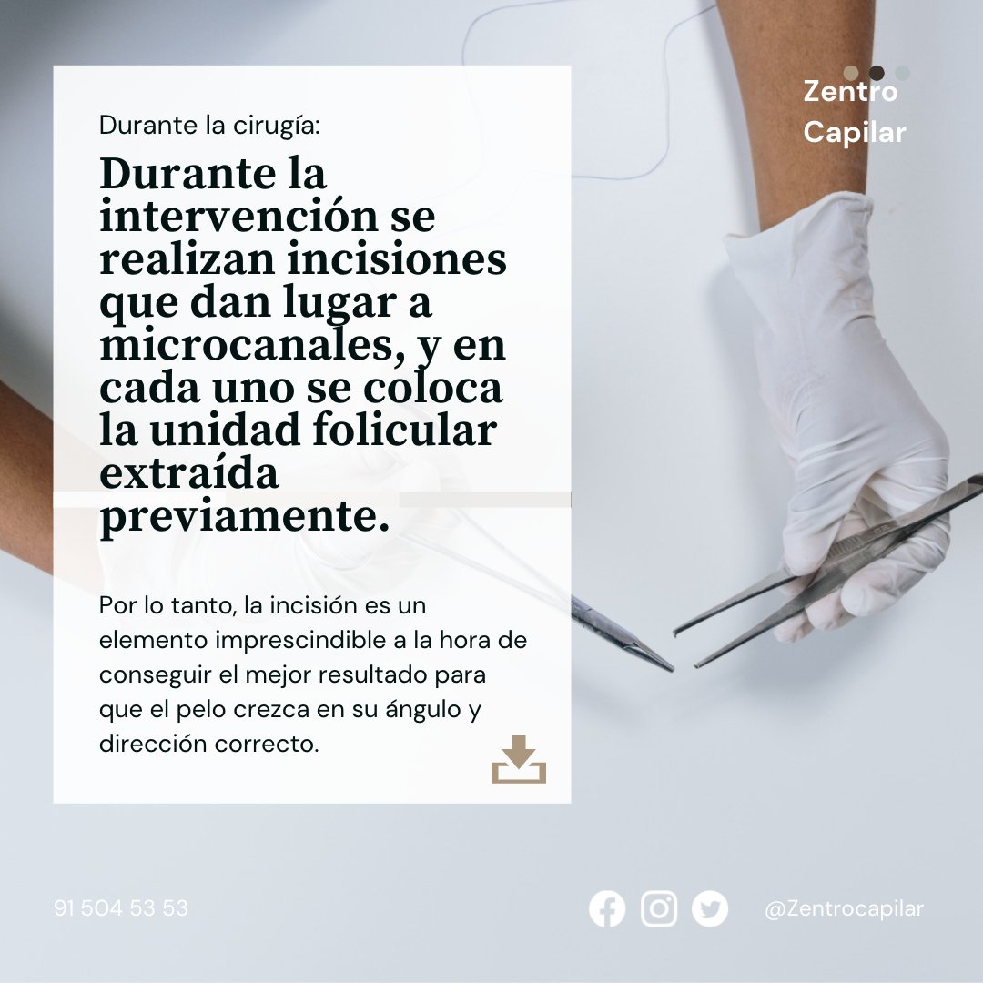 ZCapilar's tweet photo. 💉¿Ofrece ventajas el bisturí zafiro?

🤔Pues si, pero depende igualmente del paciente, por eso el convencional funciona igual de bien. Nosotros evaluamos lo mejor para el paciente, y en función de su salud actuamos. 

#capiclinic #injerto #cirugia #implante #madrid #bisturí https://t.co/u8HQwyXTXY