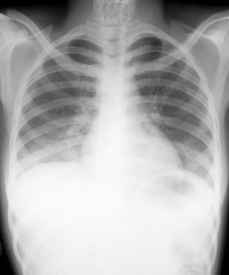 #OnThisDay in 1943 Streptomycin, the first antibiotic remedy for tuberculosis, was isolated by researchers at Rutgers University.

Image: x-ray showing a patient with tuberculosis and HIV.