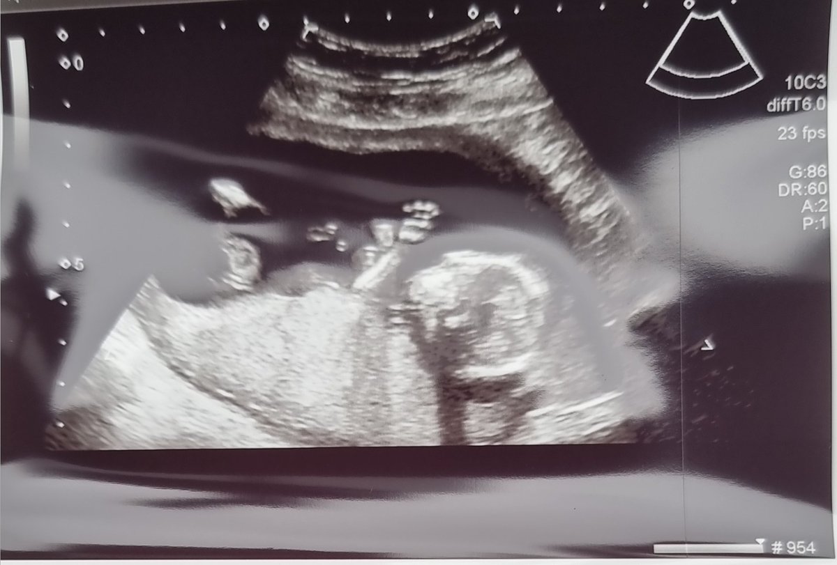 SamLFC97's tweet image. Yo Twitter, I'm going to be a Dad😊