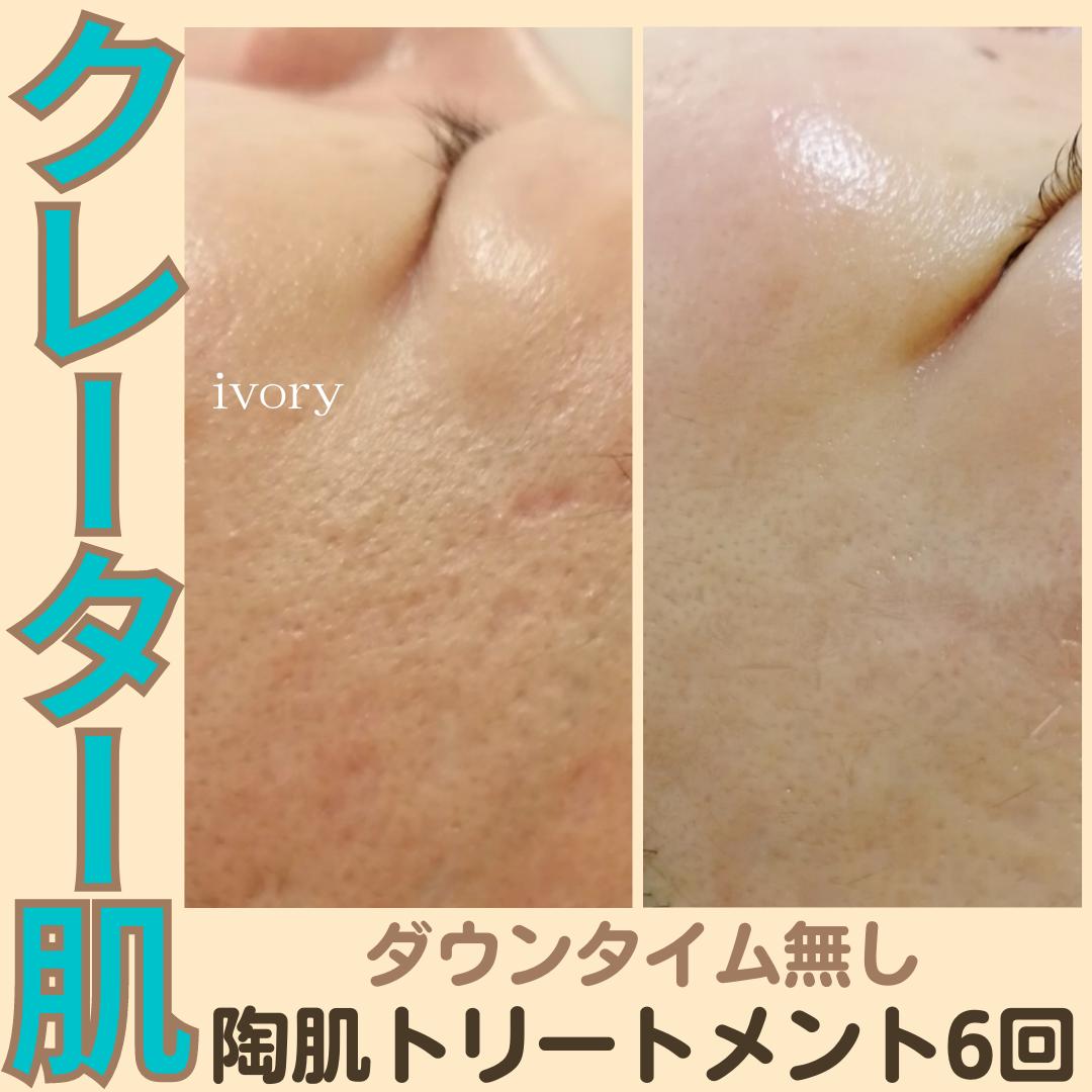 全身美肌改善REVIハーブピーリング&肉割れ炭酸ガス 全身美肌改善REVIハーブピーリング&肉割れ炭酸ガス