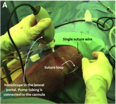 ArthroscopyJ's tweet photo. Needle arthroscopy and meniscal repair - not mutually exclusive! Check out this technique article from Stornebrink et al in Arthroscopy Techniques for details. 💉🦵
#needlearthroscopy #allinsiderepair #meniscus
https://t.co/eAKAHpgf82 https://t.co/s9FG1WfDxC