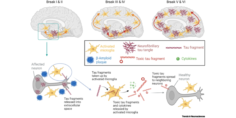 TrendsNeuro's tweet photo. ‘Untangling the relationship between microglia and tau in Alzheimer’s disease’

@TrendsNeuro ‘Spotlight’ by Samantha M. Rossano &amp; William C. Kreisl

https://t.co/AUVawOTdhw

discussing Pascoal et al. @NatureMedicine, @TharickAPascoal @PedroRosaNeto

https://t.co/6AbLpRS9oG https://t.co/MUEICqByNr