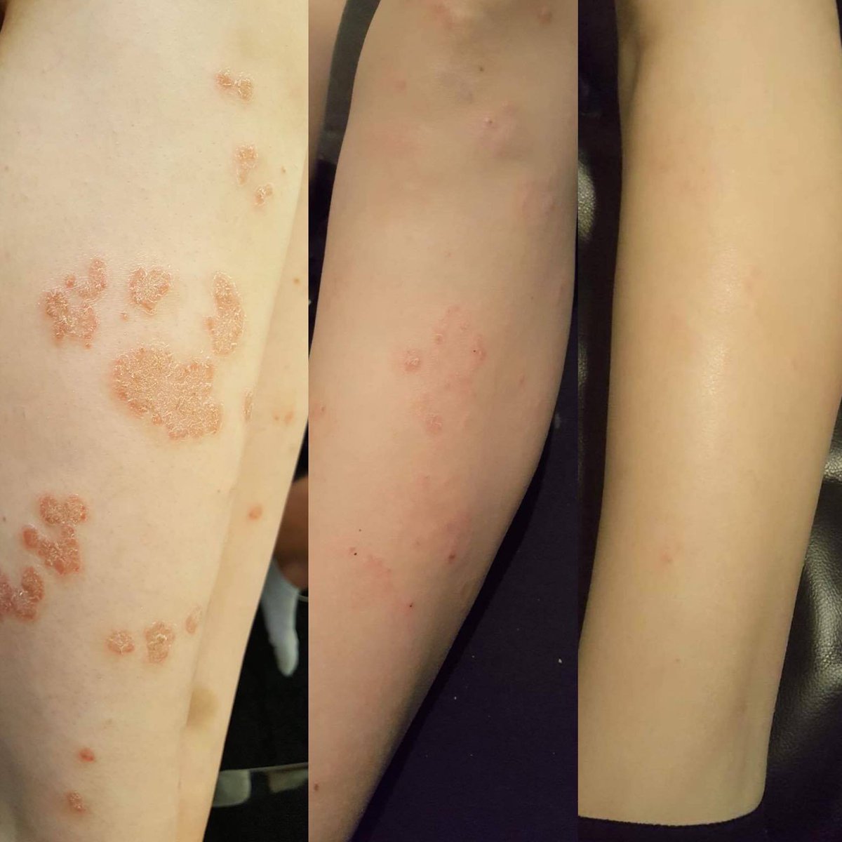 Cannamor-Wholesale (@thedreamherb) on Twitter photo Healing Balm is made with oil derived from cannabis grown indoor in Switzerland.
laura@cannamor.es
cannamor-wholesale.com
#psoriasis #eczema #cbd #Hemp Healing Balm is made with oil derived from cannabis grown indoor in Switzerland.
laura@cannamor.es
cannamor-wholesale.com
#psoriasis #eczema #cbd #Hemp