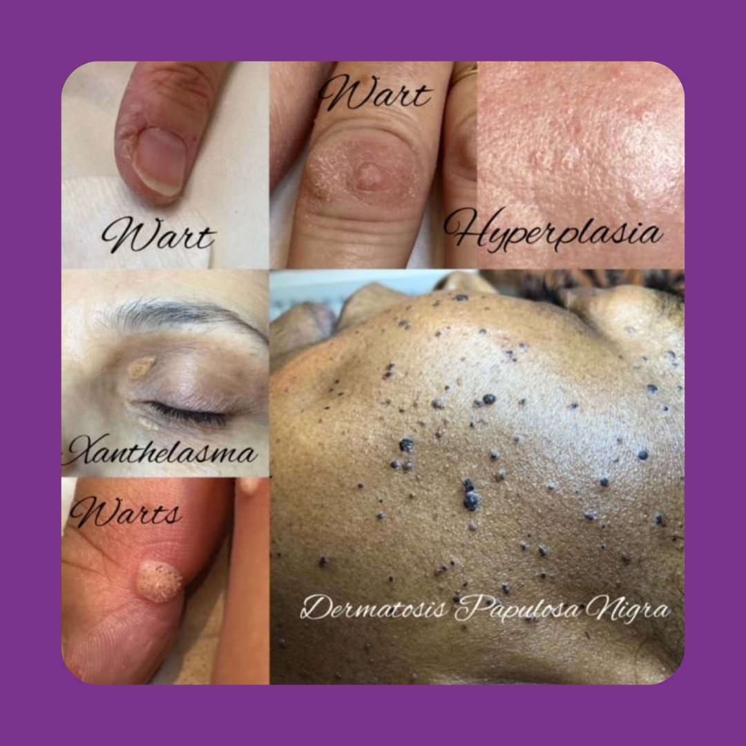 Can you help?  Models required for our Level 5 Cert in Advanced Blemish Removal assessments - 22nd, 23rd and 24th November

Do you have on of the following?

Warts
Hyperplasia
Xanthelasma
Dermatosis Papulosa Nigra

Contact us 020 3332 0296.

#positivepathwayelectrolysis