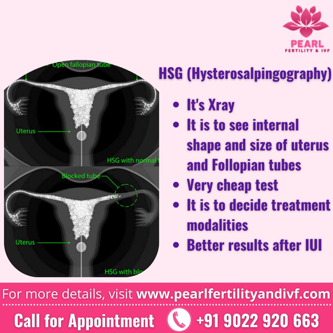 and_ivf's tweet photo. Hysterosalpingography (HSG) play's important role in treatment of Infertility. Our success rate after IUI is best because of pre IUI  HSG. Consult our experts for more details #IUI, #infertility #iuitreatment #IVF #fertility #ivfsuccess #ICSI #HSG #ivfsupport #iuisuccess https://t.co/Idd2YrKpTO