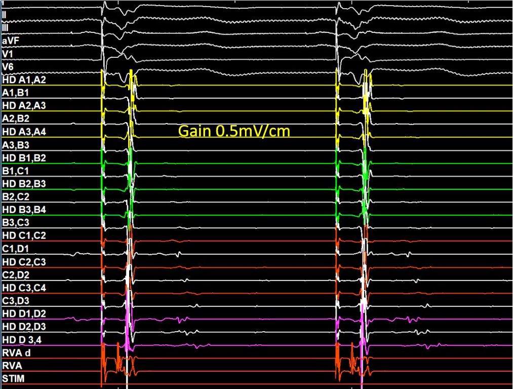 EhdaieMd's tweet photo. #EGM Gods dropped another spectacular recording during #ablateVT. Too good to be true? 

Far field ☑️ 
Near field ☑️ 
Far field ☑️ (🤔again?) 

F-N-F signal: suspected recording of mid-myo steep activation gradient (“decel”) at septum w BiVp (NICM). Not seen w septal RVp (pic3) https://t.co/22q1PrlLhU