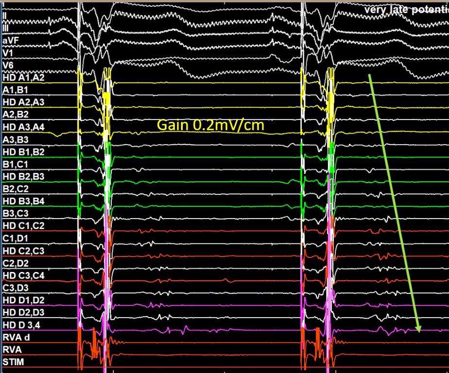 EhdaieMd's tweet photo. #EGM Gods dropped another spectacular recording during #ablateVT. Too good to be true? 

Far field ☑️ 
Near field ☑️ 
Far field ☑️ (🤔again?) 

F-N-F signal: suspected recording of mid-myo steep activation gradient (“decel”) at septum w BiVp (NICM). Not seen w septal RVp (pic3) https://t.co/22q1PrlLhU