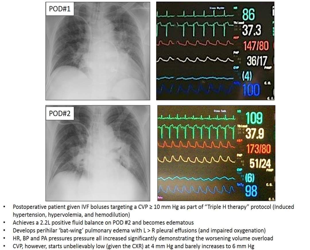 Landsberg Manual on Twitter ""TripleH" therapy for cerebral vasospasm