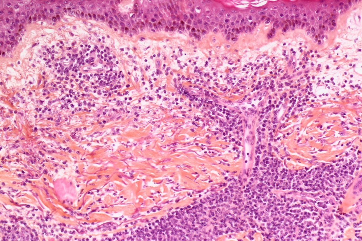 BattistellaMD's tweet photo. 🕵️rare differential of Sezary syndrome. Male around 60. multiple papules of knees and elbows. Fatigue.
What are your thoughts? any IHC? #hemepath #dermpath #pathchallenge #notjustanotherCTCL @alegru18 @drpabloortiz @JMGardnerMD @HENRYY_MD https://t.co/eKCs2PZfY8