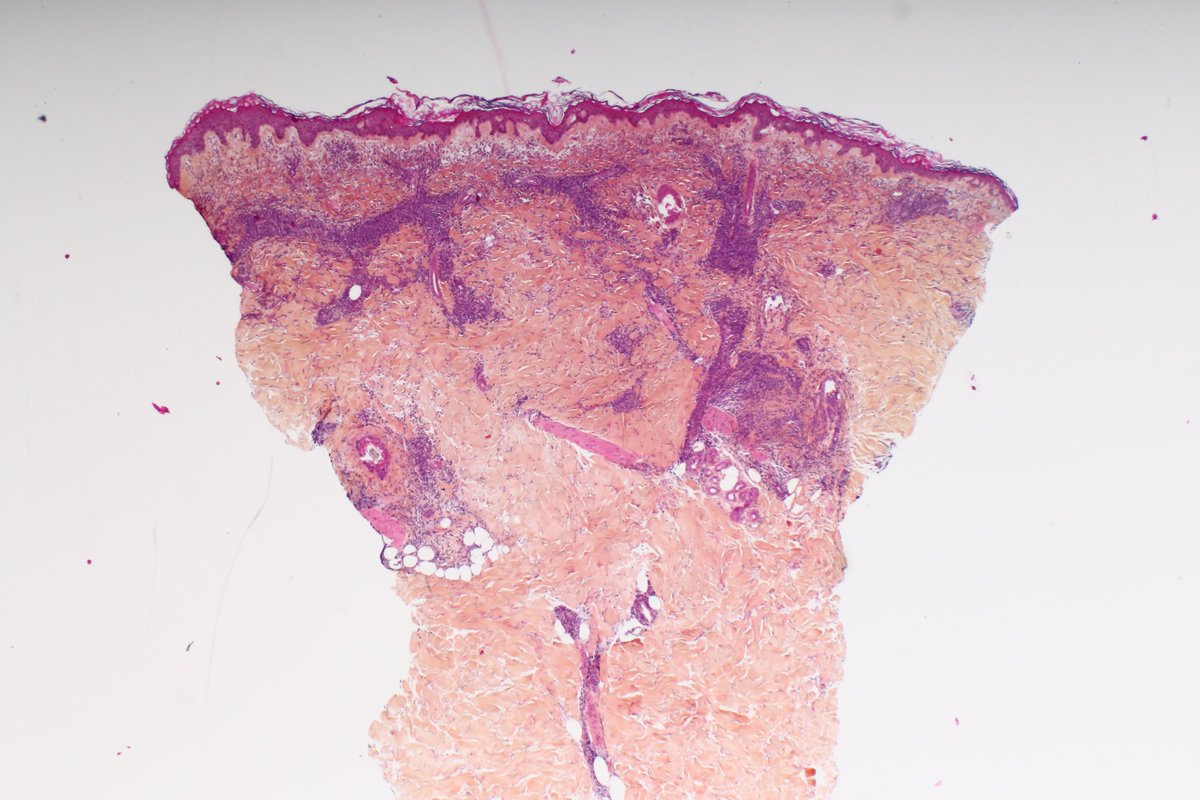 BattistellaMD's tweet photo. 🕵️rare differential of Sezary syndrome. Male around 60. multiple papules of knees and elbows. Fatigue.
What are your thoughts? any IHC? #hemepath #dermpath #pathchallenge #notjustanotherCTCL @alegru18 @drpabloortiz @JMGardnerMD @HENRYY_MD https://t.co/eKCs2PZfY8