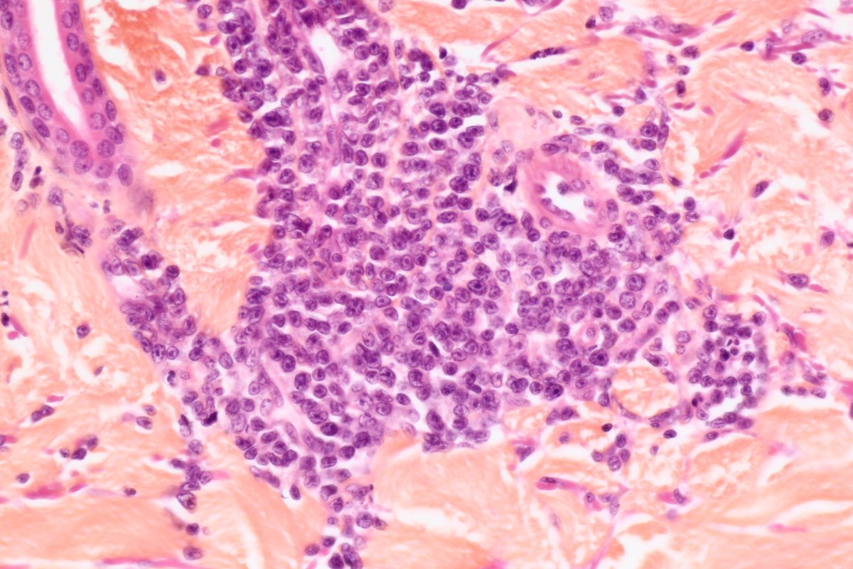 BattistellaMD's tweet photo. 🕵️rare differential of Sezary syndrome. Male around 60. multiple papules of knees and elbows. Fatigue.
What are your thoughts? any IHC? #hemepath #dermpath #pathchallenge #notjustanotherCTCL @alegru18 @drpabloortiz @JMGardnerMD @HENRYY_MD https://t.co/eKCs2PZfY8