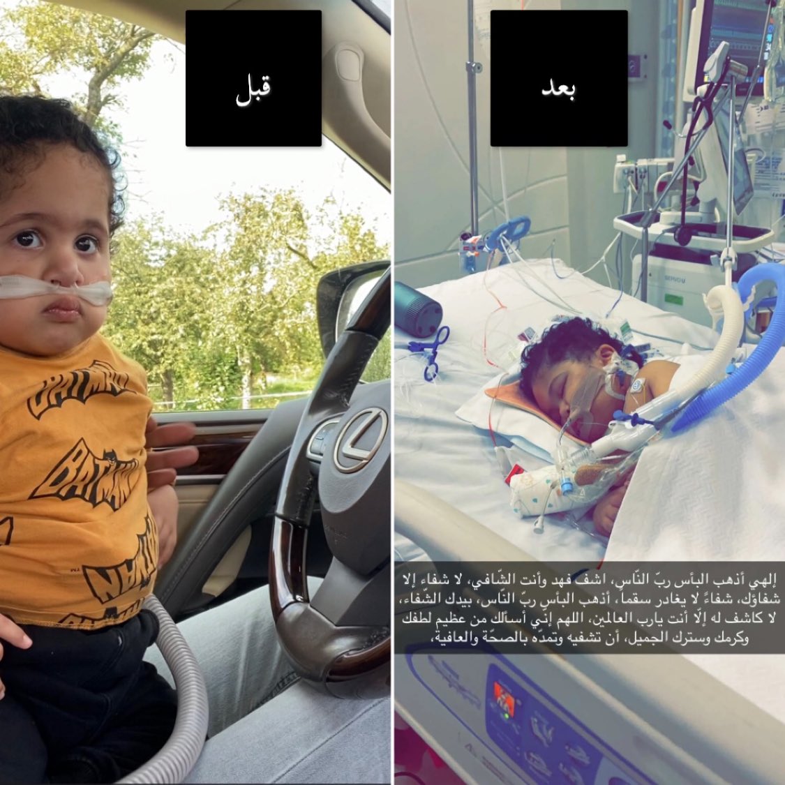 hamad_alnaimi85's tweet photo. #فهد_النعيمي وتبين تجمع الافرازات في البطن بسبب الانبوب التغذيه و تكون تسمم دم وهذا هو طفلي تحت رحمه ربه موت دماغي وغيبوبة وعلئ الاجهزه اطلب من الله ثم من سموك تحقيق في موظوع طفلي وحالته الصحيه ومحاسبه من كان السبب هاذي نتيجه اهمالهم واصرارهم علئ عودته @TamimBinHamad @MOPHQatar https://t.co/kBRy5GbLN5