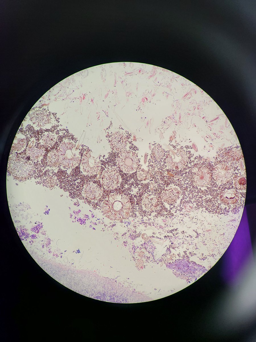 baking_md's tweet photo. When fungal sinusitis looks so pretty! #pathology #pathologyart https://t.co/zAyFrgBHOW