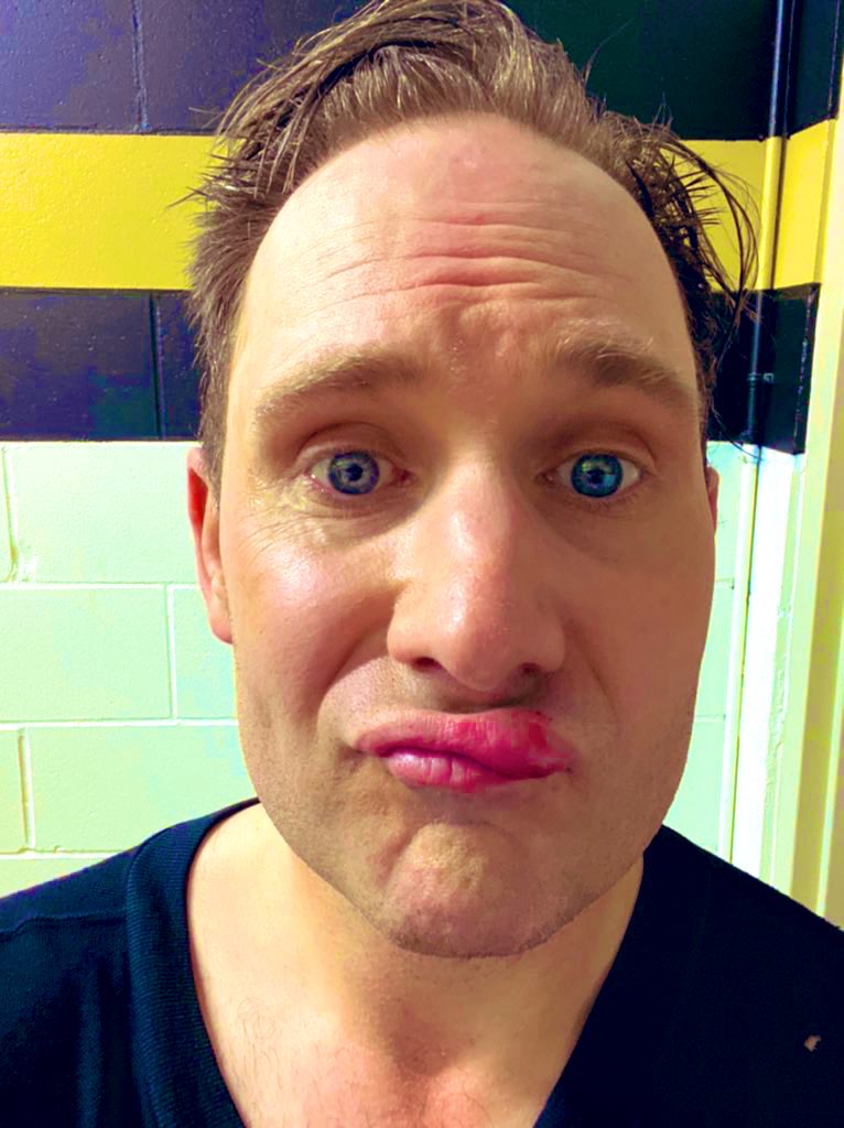 PaulHaysom's tweet image. Had to miss the show today after getting a puck to the lip last night at hockey. Wish I could say it hit my nose too, but that’s just big on its own. Thanks to the amazing @JenPalmaGlobal for filling in - this is way cheaper than Botox… #FullCageComing @canucksalumni #PuckFace