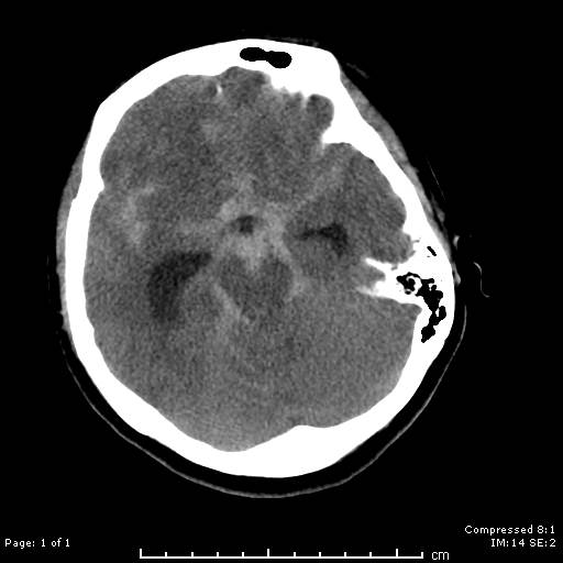 Some of us had to stay <a href="/InovaHealth/">Inova</a> and work! #SAH with 3.7mm wide-necked dorsal carotid wall #brainaneurysm treated with @MV_Terumo #scepter balloon-assisted <a href="/Stryker_NV/">StrykerNeurovascular</a> Target Nano coiling <a href="/cvsection/">CV Section</a> <a href="/CNS_Update/">CNS</a> #CNS2021