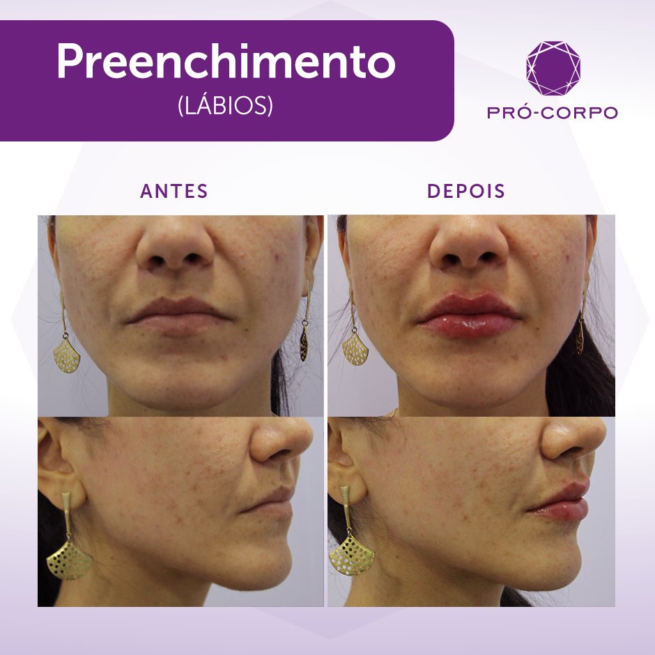 ProCorpo's tweet image. Descubra como é ter lábios volumosos e hidratados com o Preenchimento. 👄

Me diz aqui nos comentários, qual região você deseja fazer o Preenchimento?✨

#preenchimento #preenchimentolabial #labios #boca #estetica #selfcare #selflove
