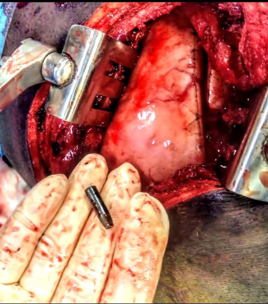 the_beardedsina's tweet photo. 20-10-2020

This is a picture of Bullet that we removed from the Chest of an #EndSARS protester who was shot

Luckily he was brought to the hospital and survived, some people died. Today we remember everyone who lost their lives #EndSARSMemorial 

Retweet let the world see https://t.co/nLNDuchR8y