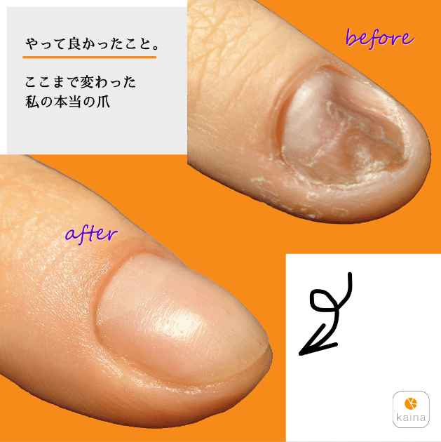 爪のお悩みはプロのギタリストもご愛用の本格派ネイルケア Kaina 爪の無料診断付 こんばんは いつの間にやら秋 冬っぽい季節になってきましたね そして空気も乾燥してきますので 爪の保湿をこまめにどうぞ 深爪 爪のでこぼこ 自爪の育成