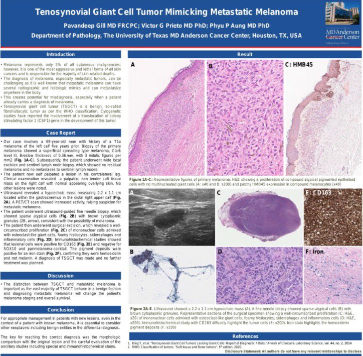 Tenosynovial Giant Cell Tumor Mimicking Metastatic Melanoma by <a href="/PavandeepGillMD/">Pavandeep Gill</a> <a href="/vgprieto14/">Dr. Victor Prieto</a> <a href="/DrPhyuPAung2/">Dr Phyu P Aung</a> <a href="/MDAndersonNews/">MD Anderson Cancer Center</a> #dermpath #ASDP21