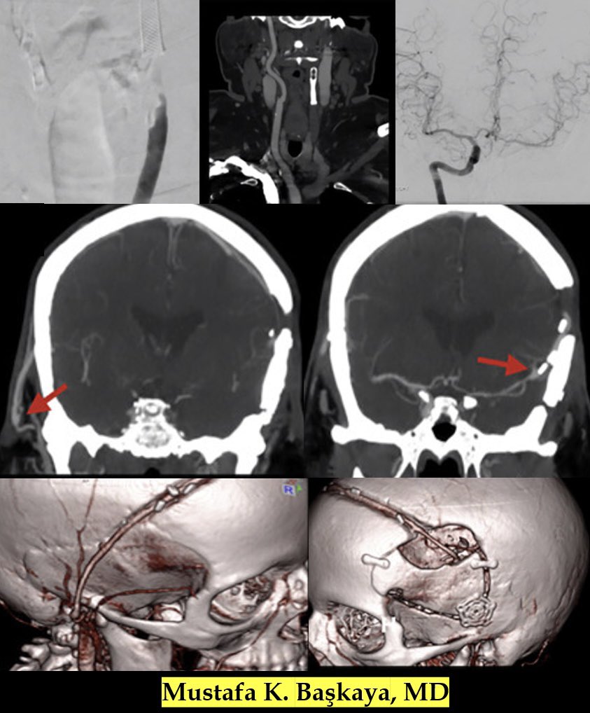 DrBaskaya's tweet photo. Bonnet #bypass
✅ https://t.co/hyGWLMXmKe
👉Previous L CEA treated with stenting for restenosis
👉transient ischemic attacks &amp; #infarctions while on multiple antiplatelet &amp; anticoagulant therapies
👉 no filling of CCA, ICA &amp; ECA on L
👉 Patent bypass at 18m F/U #nsgy #MedTwitter https://t.co/FyWtBD4tM4