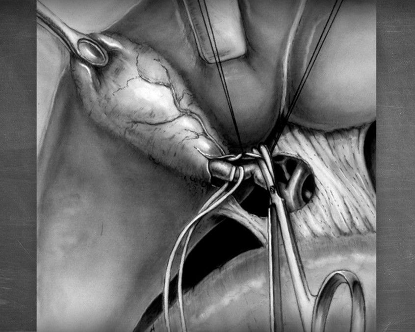 Medillustrates's tweet photo. "Cholecystectomy" by #AdduciStudios: "This piece shows the bisection of the cystic artery, prior to the surgical removal of the gall bladder."
Explore more by Paula Adduci on the https://t.co/H8gy5OpzYt site.
#cholecystectomy #gallbladder #bisection #sciart #medicalillustration https://t.co/AopfjOuXJw
