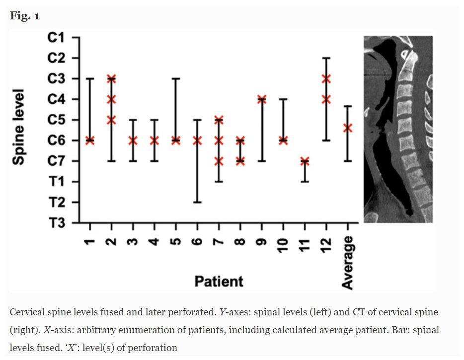 VUMC Otolaryngology–Head and Neck Surgery (@vanderbiltent) on Twitter photo *Using a retrospective chart review on patients w/ #AnteriorCervicalHardware & delayed #UpperAerodigestiveTractPerforation, this study investigated swallowing outcomes b/n treatment approaches for delayed UADT perforation.
<a href="/BenCamp21308807/">Ben Campbell</a> <a href="/CallMe_JN/">Jean-Nicolas Gallant</a> <a href="/BFStephensMD/">Byron Stephens, MD, MSCI</a> <a href="/SarahLRohde/">Sarah Rohde</a> *Using a retrospective chart review on patients w/ #AnteriorCervicalHardware & delayed #UpperAerodigestiveTractPerforation, this study investigated swallowing outcomes b/n treatment approaches for delayed UADT perforation.
<a href="/BenCamp21308807/">Ben Campbell</a> <a href="/CallMe_JN/">Jean-Nicolas Gallant</a> <a href="/BFStephensMD/">Byron Stephens, MD, MSCI</a> <a href="/SarahLRohde/">Sarah Rohde</a>