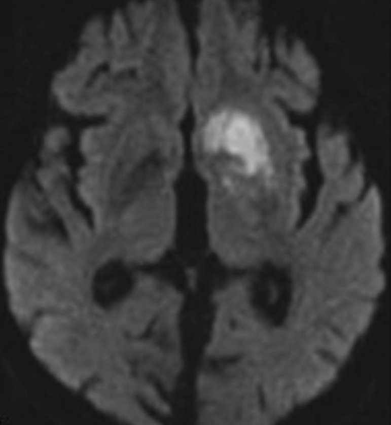 PeteFiesterMD's tweet photo. Recurrent A. Heubner 🔁 Medial LS of A2 ACA 🧠
✅ Parallels course of A1 ACA
✅ Supply ant. perf substance & anteroinferior caudate/IC/putamen
✅ #Stroke = contralateral hemiparesis, dysarthria, behavior🔺️
#radres #FOAMrad #radiology #neurology #neurores #MedEd https://t.co/Ur5ujQX0bH