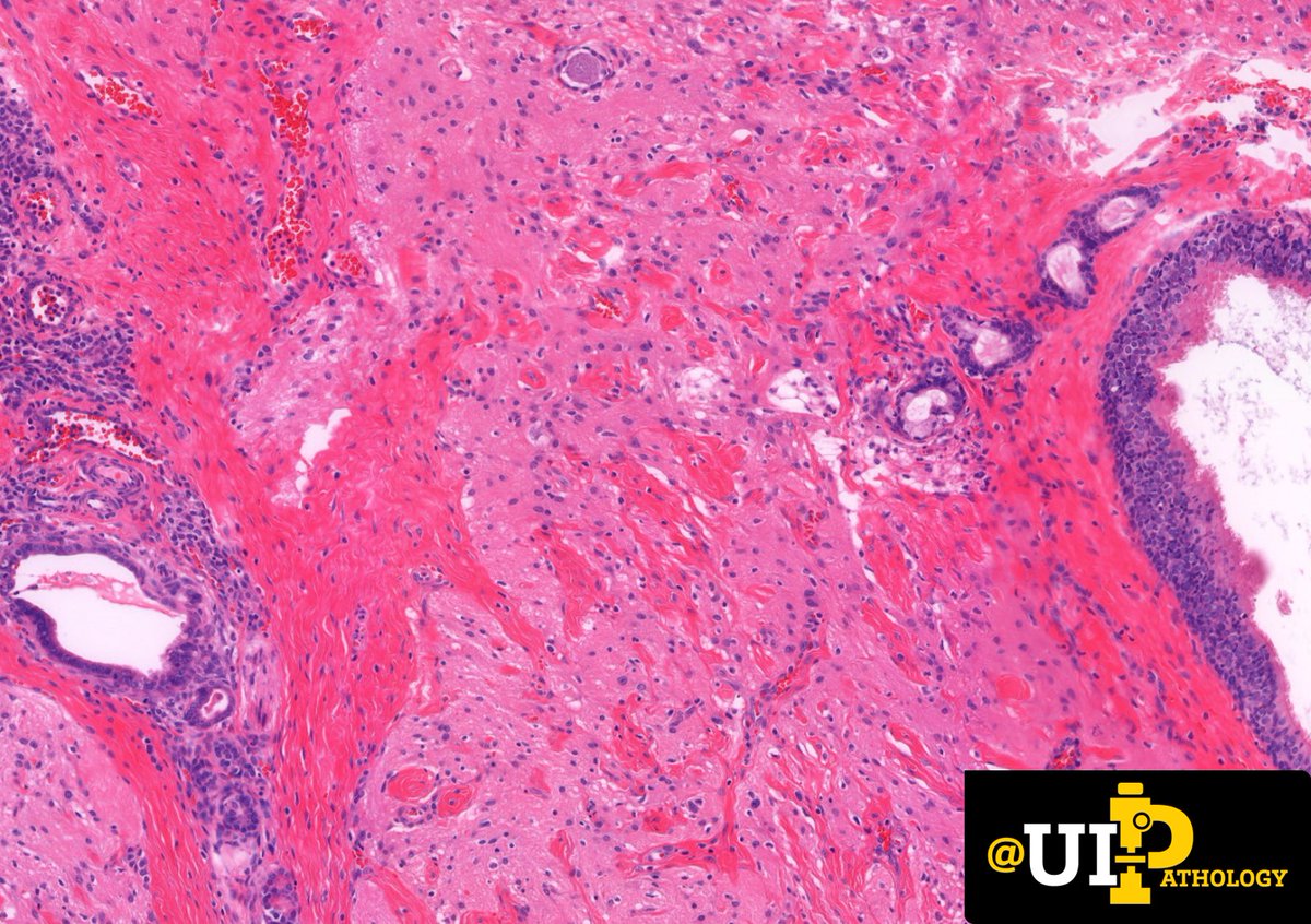 UIPathology's tweet photo. Sacral mass in a newborn. What is your diagnosis? #IowaPath #PediPath 
📸: @tracyshalvorson @laakness1 @JDavickMD https://t.co/Mt5rkq0D9l