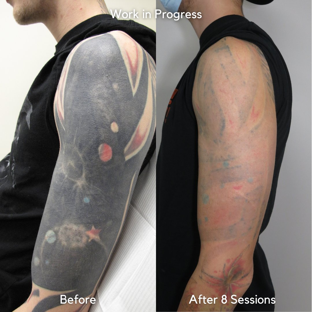 Twitter 上的 GO Tattoo RemovalAt just about the tail end of this half sleeve  removal    Every tattoo will have different results we post a wide  variety of images to